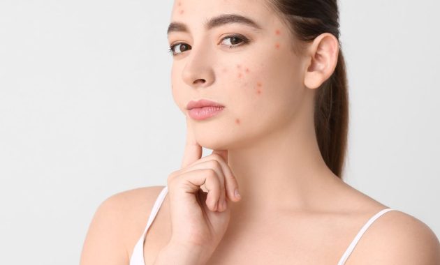 Hormon Penyebab Jerawat