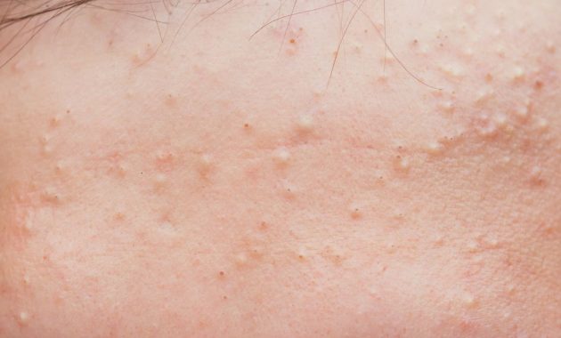 Makanan Penyebab Jerawat