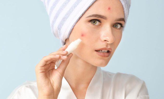 Penyebab Jerawat di Pipi?