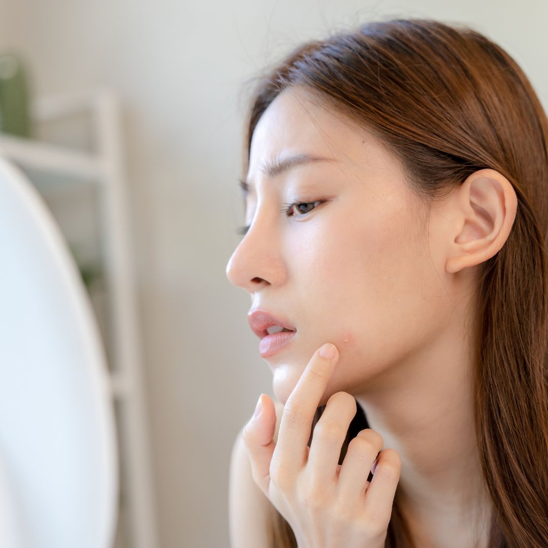 Cara Mengatasi Jerawat di Pipi