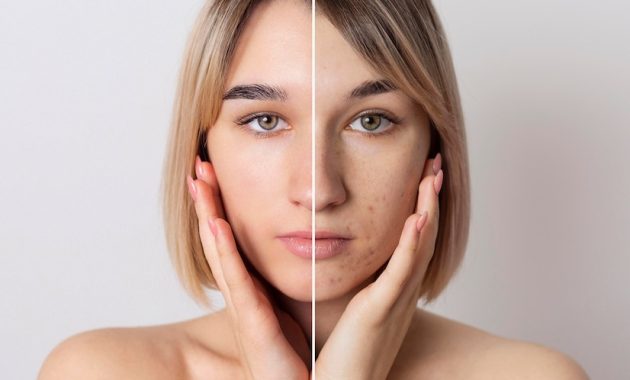 hyaluronic acid moisturizer