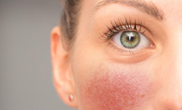 Moisturizer hyaluronic acid