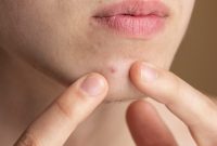 feat40 jerawat di jidat