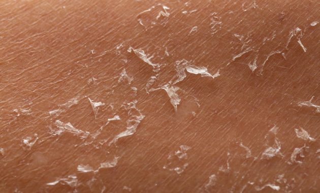 sel kulit mati  jerawat di jidat