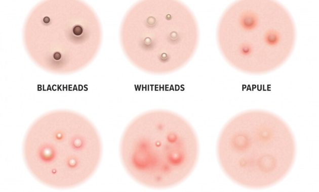 obat jerawat ampuh jerawwat