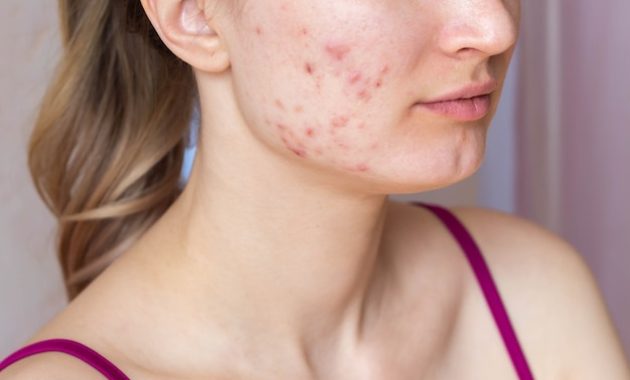 cara menghilangkan jerawat