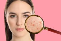 fea39 art40 jerawta di dagu jerawat di jidat