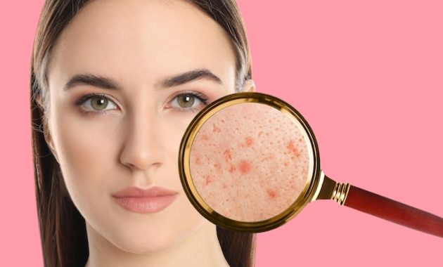 jerawta di dagu jerawat di jidat